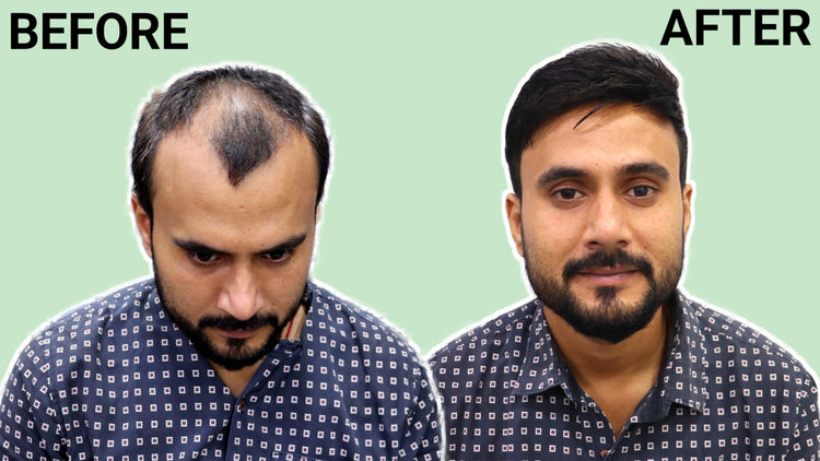 Malhotra Hair Replacement